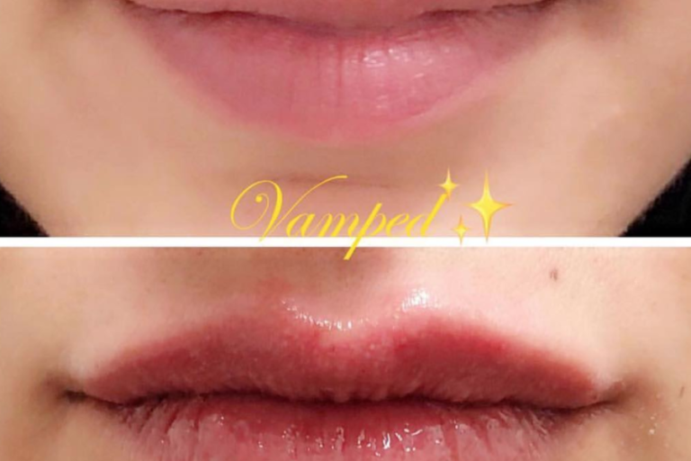 half syringe lip filler before and after aestheticlipsinfo.com